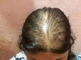 There are various treatment options for female hair loss, including topical medications, such as rogaine. Few Things To Know About Female Pattern Hair Loss Dermaclinix