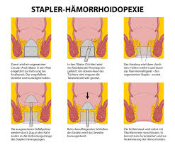 Der darm des menschen besteht aus verschiedenen teilen: Welche Vier Stadien Der Hamorrhoiden Erkrankung Gibt Es