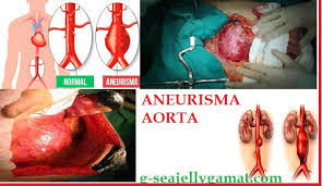 Klikdokter.com aneurisma merupakan suatu kondisi di mana terdapat tonjolan yang abnormal dari aneurisma dapat pecah atau ruptur, yang menyebabkan perdarahan internal dan dapat berujung. Menilik Aneurisma Aorta Penyakit Bom Waktu Yang Menyerang Bondan Winarno
