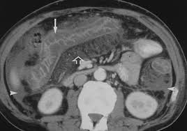 Image result for Neutropenic Colitis
