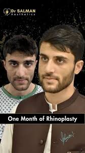 One Month Rhinoplasty results.., #drmsk #drsalman #fue #rhinoplasty  #rhinoplasty #nosereshaping #perfectnose #plasticsurgeon