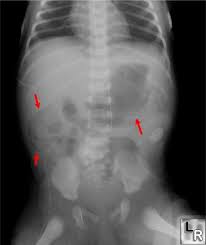 Image result for Necrotizing Enterocolitis