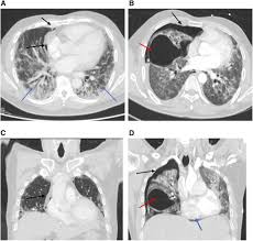 We did not find results for: Case Report Covid 19 Related Pneumothorax Case Series Highlighting A Significant Complication In The American Journal Of Tropical Medicine And Hygiene Volume 103 Issue 3 2020
