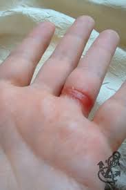 Allergic Reaction To Liquid Soap Under The Wedding Ring Skin Allergies Allergy Eyes Beauty Nails