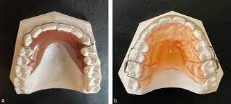 Removable Orthodontic Retainers Practical Considerations British Dental Journal