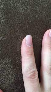 Bei beschädigungen am gelnagel können sich durch das auswachsen aber auch bakterien oder pilze bilden. Liftings Oben Am Rand Acrylnagel