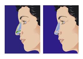 Image result for Sinus Surgery