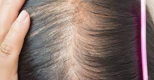 Pcos And Hair Loss Mypcosteam
