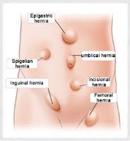 Incisional Hernia Repair The Procedure Risks Complications Preparations And More Hernia Repair Thyroid Surgery Medical Surgical Nursing