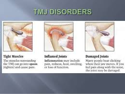 Homeopathy For Temporomandibular Joint Disorder Healthcare Health Lifestyle Healthtip Temporomandibular Joint Homeopathy Temporomandibular Joint Disorders