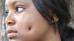 A dimple (also known as a gelasin) is a small natural indentation in the flesh on a part of the human body, most notably in the cheek. Dimpleplasty Woman Gets 1 500 Cheek Piercing Surgery To Get Dimples Like Cheryl Cole Huffpost Uk Life