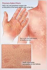 Check spelling or type a new query. Pityriasis Rubra Pilaris Jama Dermatology X Mol
