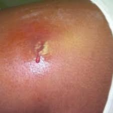 In the community (where you live, work, shop, and go to school), mrsa most often causes skin infections. Mrsa Doccheck Flexikon