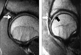 Image result for Hip Labral Tear