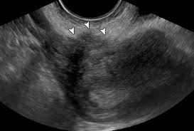 Check spelling or type a new query. Findings Of Pelvic Endometriosis At Transvaginal Us Mr Imaging And Laparoscopy Radiographics