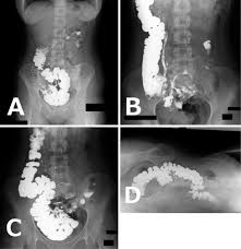 Ct Abdomen And Pelvis. Enlarged, Mobile Cecum Located In The Left Side... |  Download Scientific Diagram