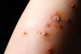 Coronary artery disease is disease in the arteries of the heart. 529 Best Gangrene Images Stock Photos Vectors Adobe Stock