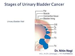 Bladder Cancer Is Any Of Several Types Of Cancer Arising From The Tissues Of The Urinary Bladder It Is A Disease In Which Cells Grow Abnormally And Pinterest