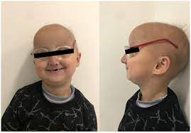 Residents and fellows contest rules | international ophthalmologists contest rules. Dental Rehabilitation Of A Rare Hallermann Streiff Syndrome With Olygodontia A Case Report