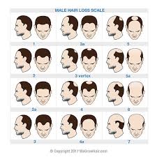 Norwood Scale Hair Loss Chart For Men With Male Pattern