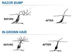 In medical terms, this is known as 'pseudofolliculitis barbae' or 'sycosis barbae'. How Do I Handle Razor Bumps And Ingrown Hairs On My Ethnic Skin