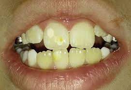 Mih home is one of the leading building materials company, supplier, & retailer in the uae, since 1975. Upper Right Incisor Showing Both Mild And Moderate Mih Lesions Download Scientific Diagram