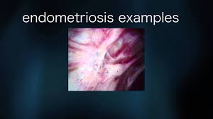 Endometriosis can be a challenging condition to manage. Endometriosis
