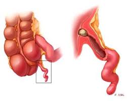 Appendicitis is a common condition that includes an inflammation of a little outpouching of the intestine, called the appendix. Appendicitis Diagnosis Evaluation And Treatment