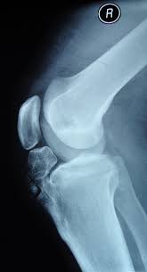 Arthroscopic Excision Of A Huge Ununited Ossicle Due To Osgood Schlatter Disease In An Adult Patient Journal Of Orthopaedic Case Reports