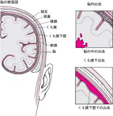 {{ login_id.substr(0, 30) }}{{ login_id.length > 30 ? ãã‚‚è†œä¸‹å‡ºè¡€ 09 è„³ è„Šé«„ æœ«æ¢¢ç¥žçµŒã®ç—…æ°— Msdãƒžãƒ‹ãƒ¥ã‚¢ãƒ«å®¶åº­ç‰ˆ