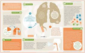 Air pollution from vehicles, industry, and power plants, can raise the likelihood of developing lung cancer in exposed individuals. Non Small Cell Lung Cancer Nature Reviews Disease Primers