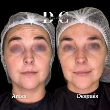 Resultado de Botox a los 14 días de inyección de Botox en ✓frente ✓patitas  de gallo ✓entrecejo ✓nasal Miren la diferencia en la dinámica facial al  hacer gesticulaciones. Esto es gracias a