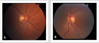 Pdf A Case Of Optic Neuritis Secondary To Lyme Disease Semantic Scholar