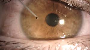 Image result for Eye Foreign Body