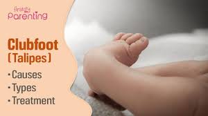 Most of the time, it is not associated with other problems. Club Foot Talipes In Babies Causes Signs Treatment Youtube