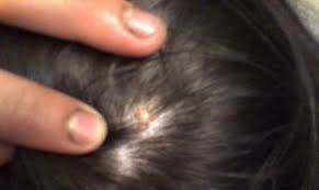 Below, the best ingrown hair treatments for smooth skin. Ingrown Hair On Scalp Female Ingrown Hair