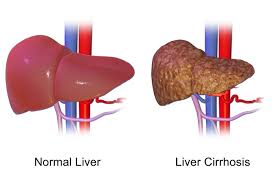 Di amerika serikat, konsumsi alkohol berlebihan dan virus hepatitis kronis (b dan c) menjadi penyebab paling umum (dipiro et al., 2015). Patofisiologi Sirosis Hepatis Alomedika