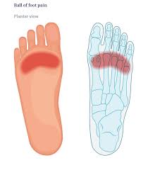 Image result for Metatarsalgia