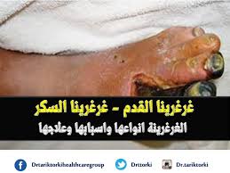 غرغرينا القدم غرغرينا السكر عياده الدكتور طارق تركى للعنايه بالقدم والقدم السكرى Facebook