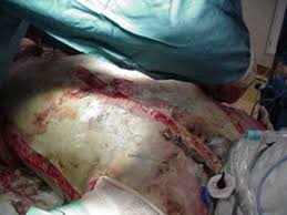 Escharotomy is defined as the surgical incision through the eschar into the subcutaneous tissues to allow the extremity to continue to swell without compressing the underlying blood vessels. Circumferential Burns Vic Burns