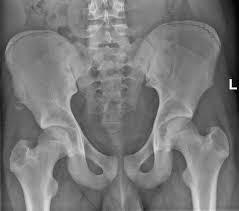 Anterior angulation of the coccyx may be a normal variant but poses a diagnostic challenge for those considering coccygeal trauma. Epos Trade
