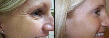 Typically the face is treated with botox. Youth Rx