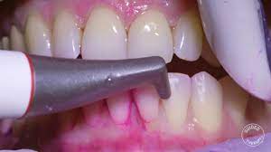 How Teeth Should Be Cleaned At The Dentist / Hygienist - Youtube