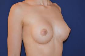 Brustvergrößerung von A auf C | mit Implantaten - Brüste vergrößern