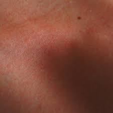 En este otro artículo ya mencioné cómo se contagia; Culebrilla Enfermedad Que Brota Con El Estres Es Contagiosa