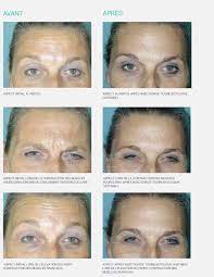 See full list on en.wikipedia.org Injections De Botox Dr Manise A Saint Malo Pres De Rennes