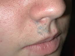 Tattoos are here to stay, and while there's currently no hard evidence to suggest that they increase the risk of cancer, there's little reason to worry. Inflammatory Tattoo Reaction Dermatology Advisor