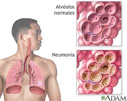 Image result for Pneumonia