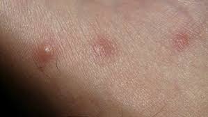 Image result for mite bites on humans