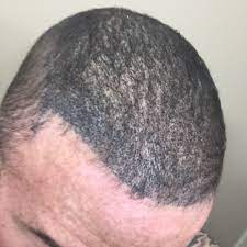 Don't miss out on savings! Hair Loss Due To Type 2 Diabetes Diabetes Forum The Global Diabetes Community